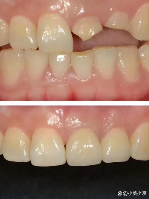 种一牙六千韩国烤瓷牙，价格合理质量有保障吗？-图3
