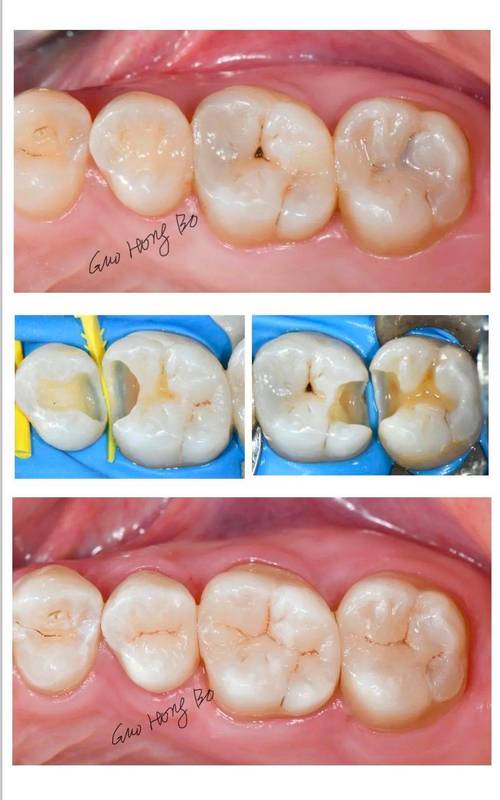 树脂牙齿抛光最简单方法-图1