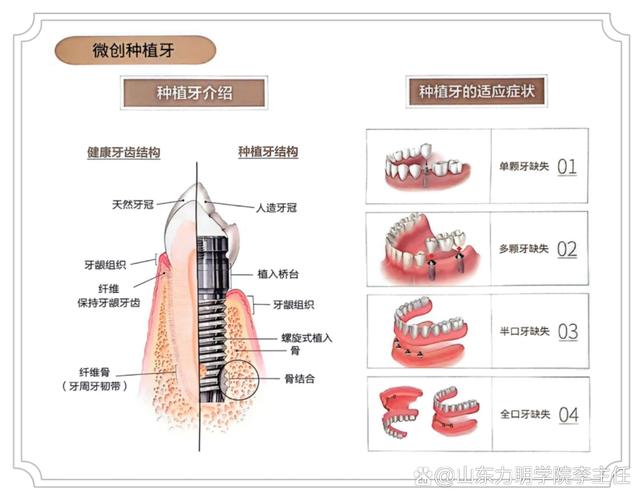 加强后牙支抗有哪几种方法？各自适用什么情况？-图1