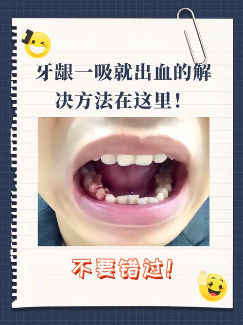 牙龈出血怎么治？具体日常护理与专业治疗方法有哪些？-图2