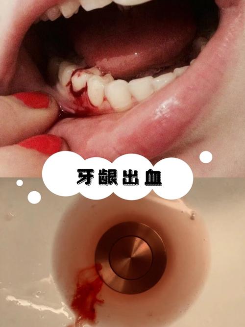 牙龈出血怎么治？具体日常护理与专业治疗方法有哪些？-图3