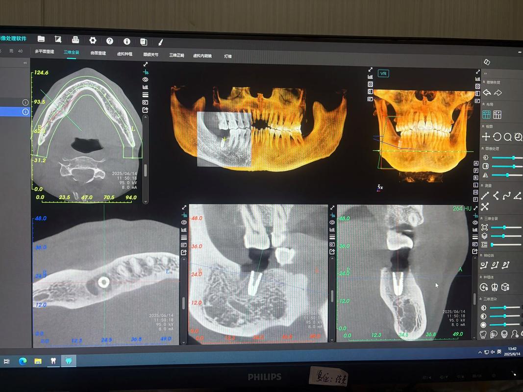 即拔即种牙从哪来？揭秘其来源之谜-图2