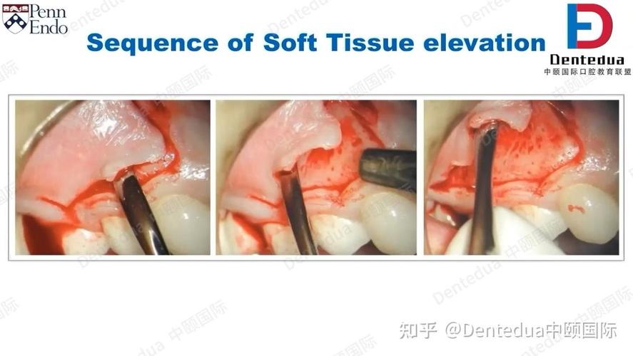 翻瓣手术缝合常用方法有哪些？-图1