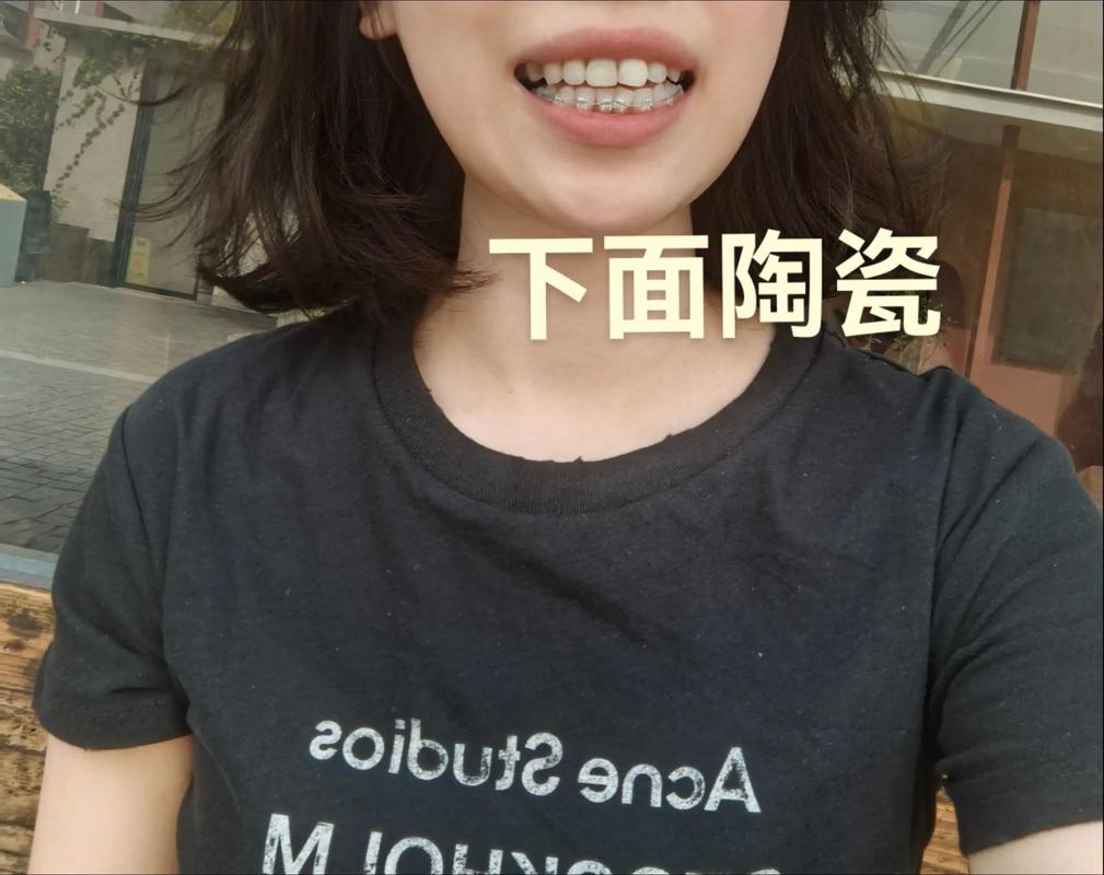 正畸舌侧扣能改到外侧吗？-图2