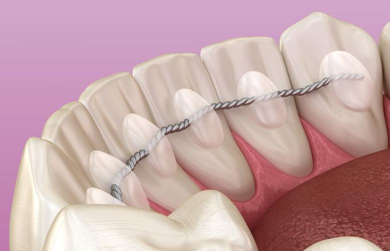 目前松牙固定术哪种方法最好？如何科学选择？-图1