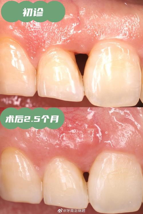 牙周骨手术后正畸治疗的最佳时机及效果如何把握？-图1