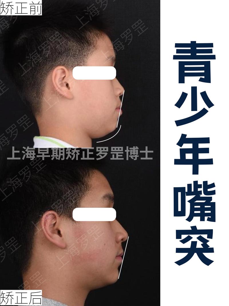 上海牙齿矫正有哪些常用方法？各自适合什么情况？-图2