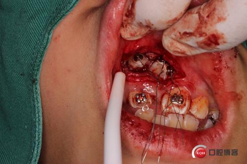 正畸牵引开窗是什么?详解其正畸治疗中的原理与作用-图2 正畸牵引开窗是什么?详解其正畸治疗中的原理与作用-图2