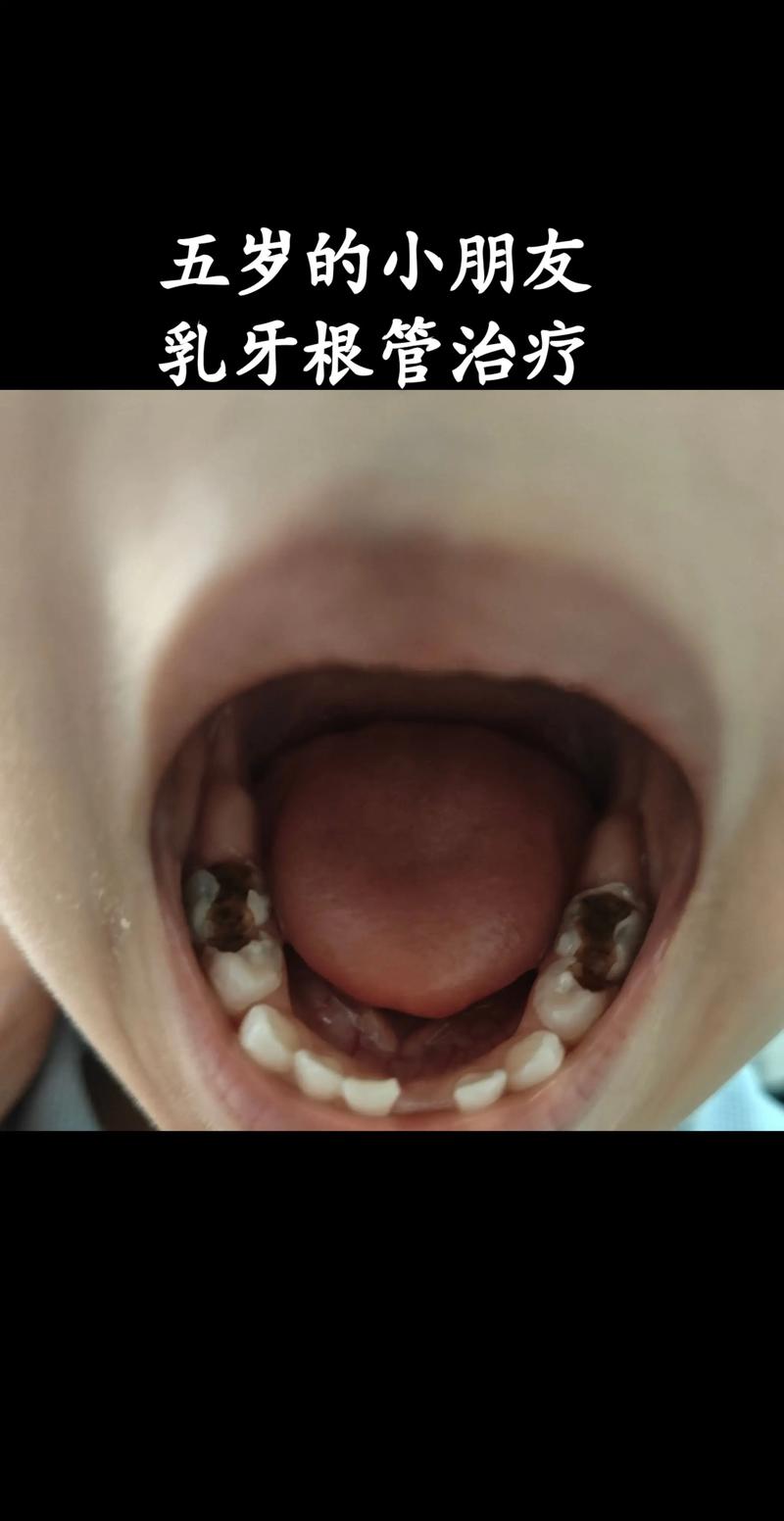 儿童烂牙齿跟管治疗方法-图3