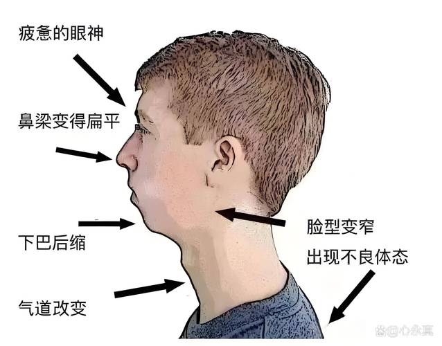 错颌畸形的主要防治方法有哪些？专家详解关键措施与适用人群-图3