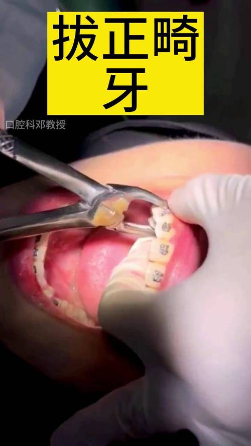 正畸时,横向阻生齿是否必须拔除?不拔会影响矫正效果吗?-图1 正畸时,横向阻生齿是否必须拔除?不拔会影响矫正效果吗?-图1