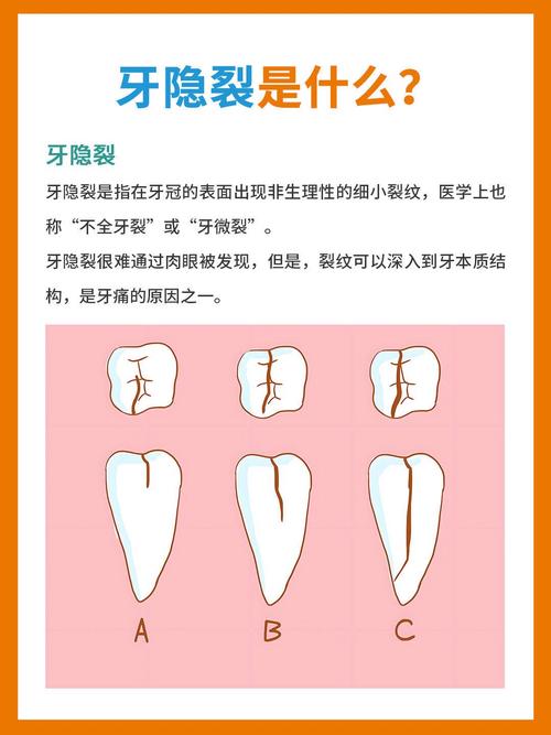 牙齿裂开最好的解决方法是什么？-图1