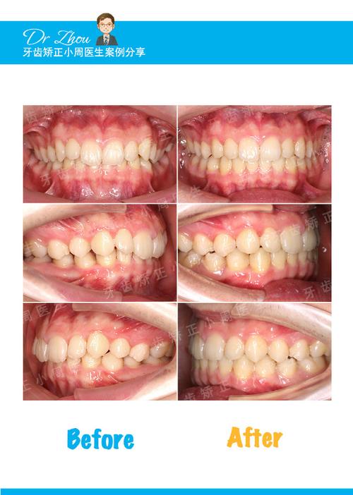 正畸快结束为何需再治疗深覆颌？-图2