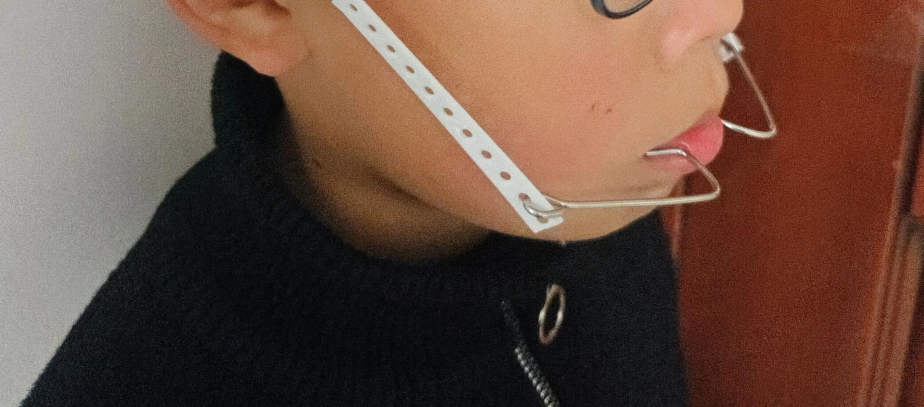 戴正畸头帽期间，还能正常吃东西吗？-图2