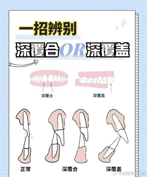 活动牙垂直距离确定方法有哪些？如何精准选择？-图2