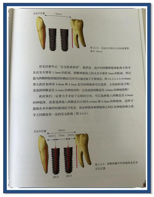 活动牙垂直距离确定方法有哪些？如何精准选择？-图1