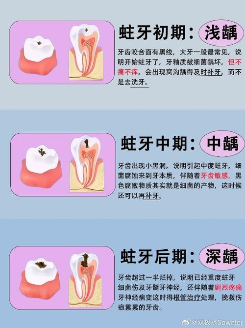 成人轻度龋齿的治疗方法-图3