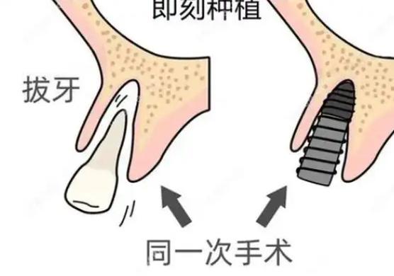 即拔即种牙怎么做到的-图3