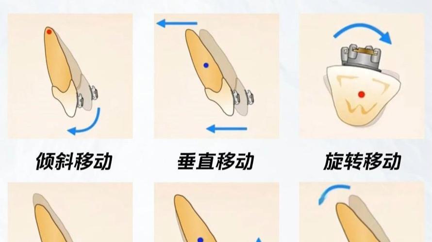 加速牙齿正畸移动的方法-图1