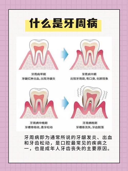 牙周炎中期如何治疗？有哪些有效方法及注意事项？-图3