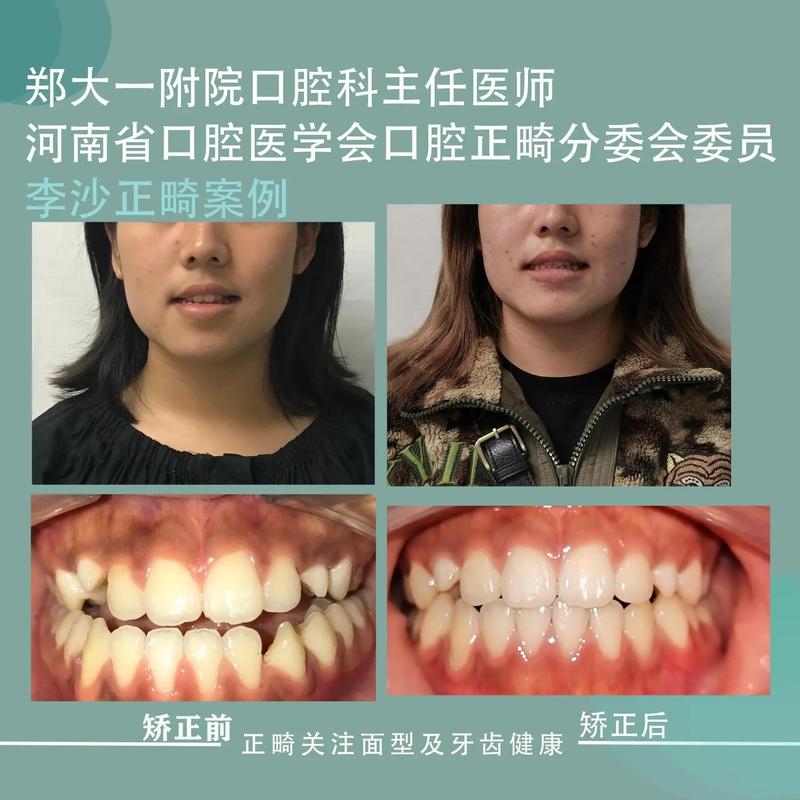 郑州牙齿正畸好的医院怎么选？求推荐靠谱正规的医院！-图3