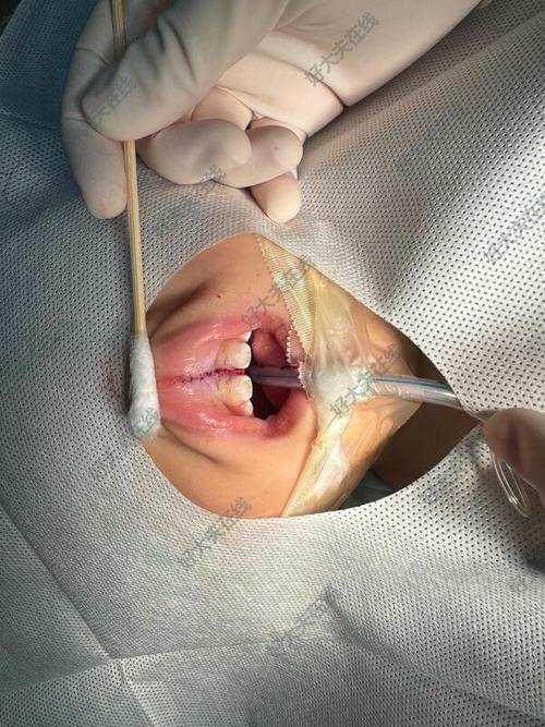 正畸钢丝压嘴唇内部痕怎么办？-图2