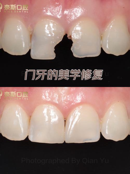 门牙修补后还能做正畸吗?-图1 门牙修补后还能做正畸吗?-图1
