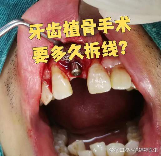 种牙植骨后骨头完全长成需要多长时间？-图3