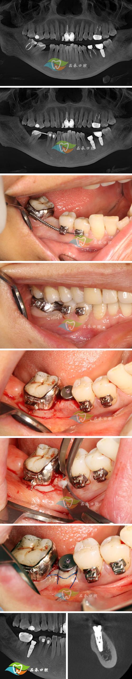 拜博口腔急拔急种牙可行吗？安全效果如何？-图2