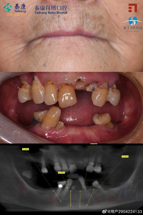 拜博口腔急拔急种牙可行吗？安全效果如何？-图1