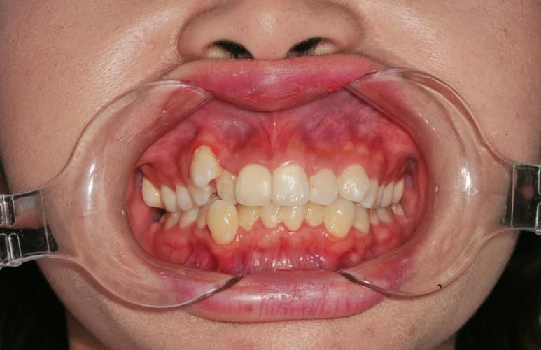 尖牙牙根突出可以进行正畸矫正吗？-图1