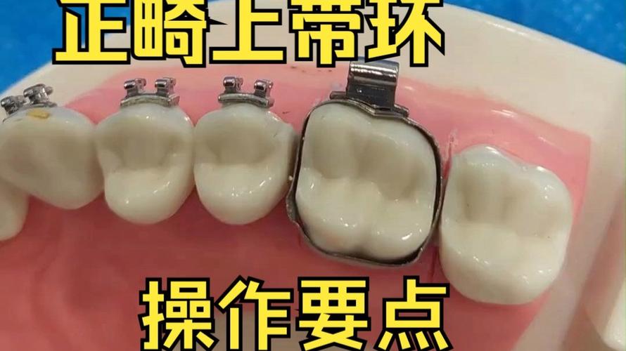 正畸期间带环的牙松动是什么原因导致的？-图1