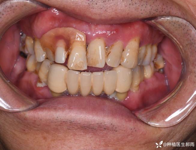 正畸期间带环的牙松动是什么原因导致的？-图2