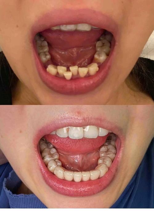 成人正畸只能选隐形矫正吗？-图3