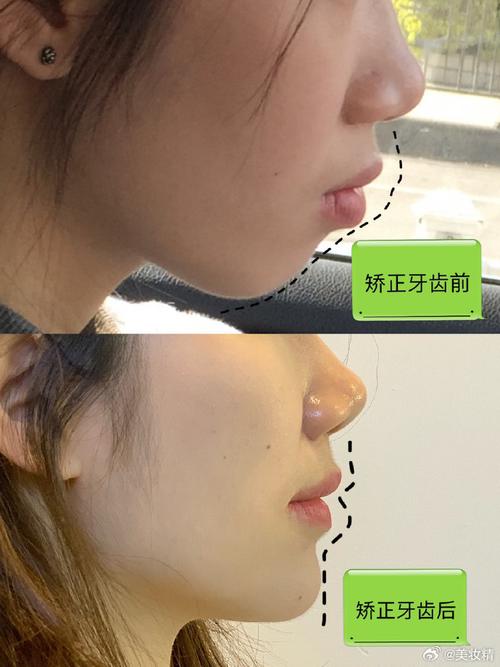 骨性龅牙正畸能治好吗？矫正效果如何？-图1