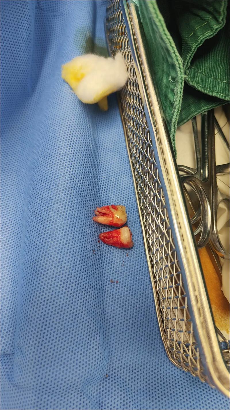 门牙两个拔掉 待种牙-图2