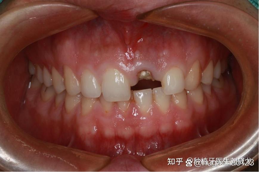 门牙两个拔掉 待种牙-图1
