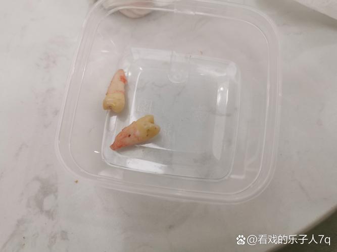 门牙两个拔掉 待种牙-图3