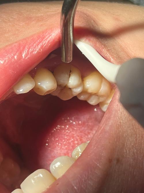 拜博口腔把牙补坏了-图1 拜博口腔把牙补坏了-图1