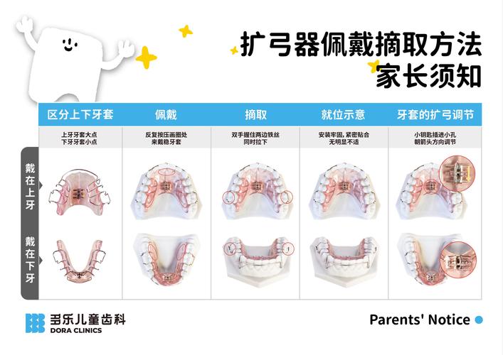 上颌扩弓器怎么用？正确步骤及注意事项有哪些-图2