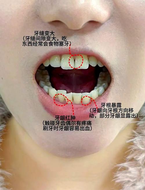 牙龈萎缩适不适合种牙？需满足哪些条件才行？-图2