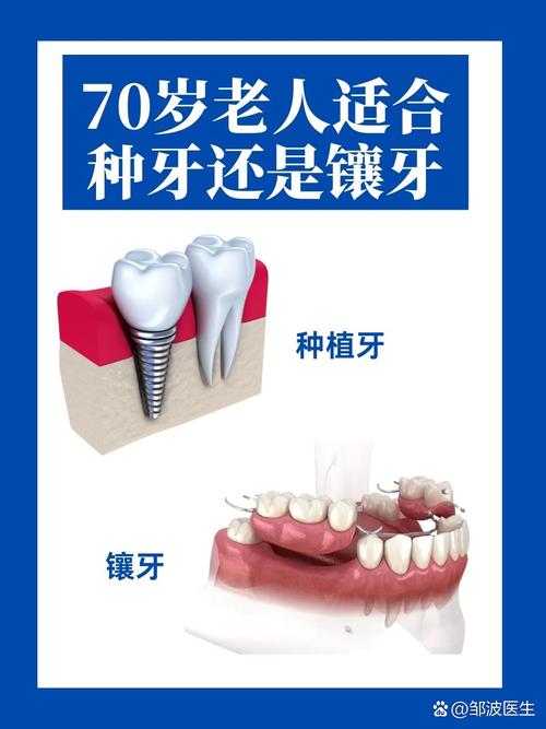 70岁老人能种牙吗?高龄种植牙可行性与条件解析-图2 70岁老人能种牙吗?高龄种植牙可行性与条件解析-图2