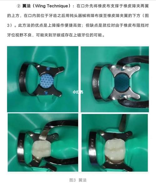 科尔橡皮障的使用方法-图1