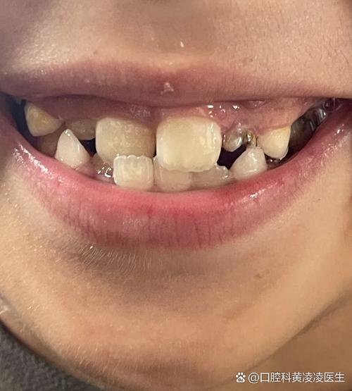 正畸会让牙齿晃动吗？牙齿移动的疑问解答-图2