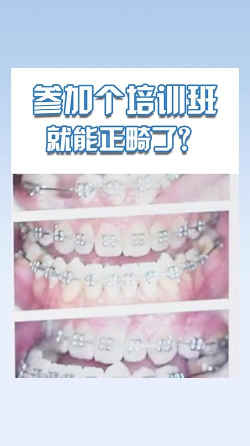 正畸去代偿到底是什么意思？-图1