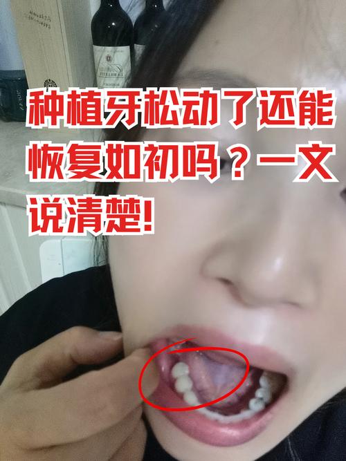 牙龈缺失严重还能种牙吗？可行性与条件是什么？-图1