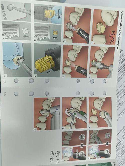 如何正确掌握纤维根管桩的使用方法与步骤？-图1