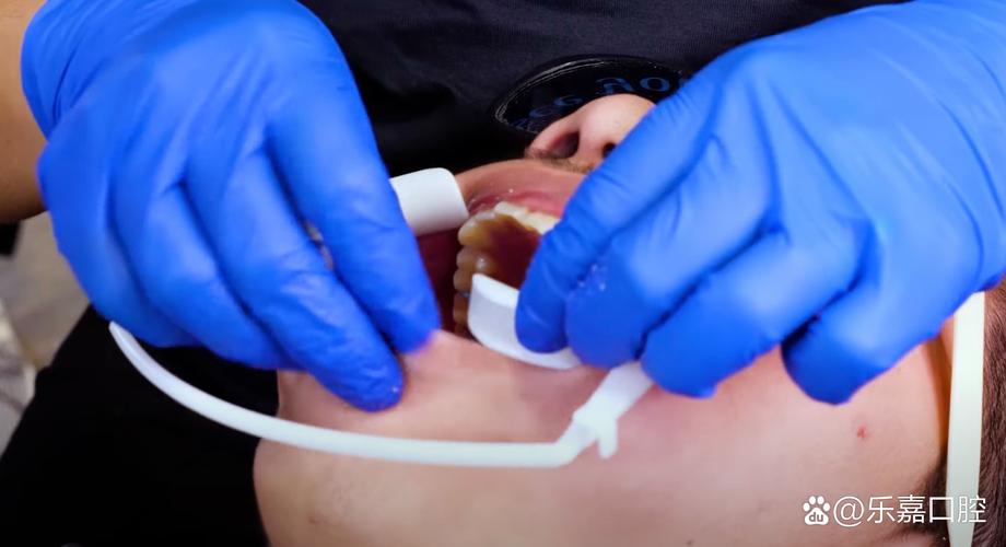 外国人整牙常用哪些方法？-图3
