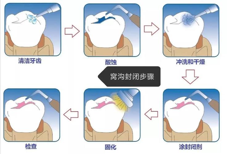 窝沟封闭剂的使用方法-图2