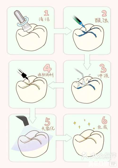 窝沟封闭剂的使用方法-图1